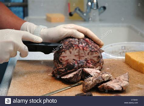 Autopsy Brain Fotos e Imágenes de stock   Alamy