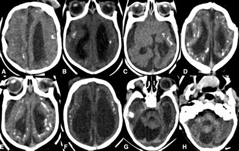Axial brain CT scan findings in congenital microcephaly ...