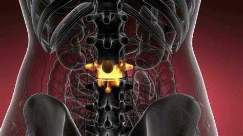 Backache in Back Bones by icetray backache in backbone ...