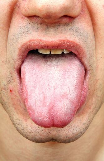 Bacterial Infection Disease Tongue Stock Photo   Download Image Now ...