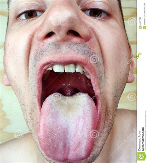 Bacterial Infection Disease Tongue Stock Photo   Image of cavity ...