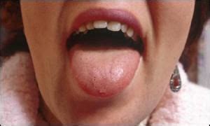 BBC News | HEALTH | Tongue cancer woman sings again