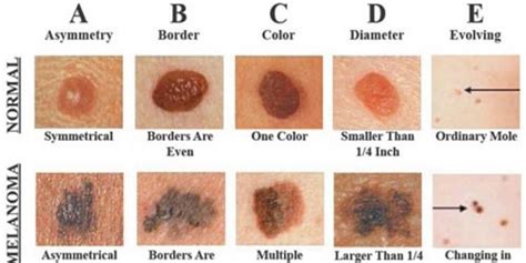Be Careful ! Early Warning Signs And Symptoms Of Skin ...