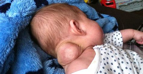 Bebé nacido con un extraño bulto en su cuello que va creciendo