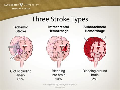 Benefits of clot removal for strokes extended to 24 hours ...