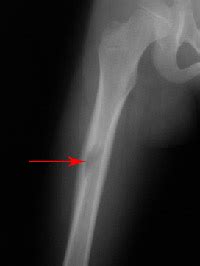 Benign and Malignant Bone Tumors | UConn Musculoskeletal ...
