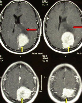 Benign Brain Tumors – Non Cancerous Tumor With images ...