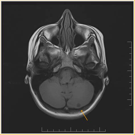 Benign Cerebellar Cyst: MRI   Sumer s Radiology Blog