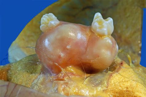 Benign mature teratoma of the ovary  2    DocCheck