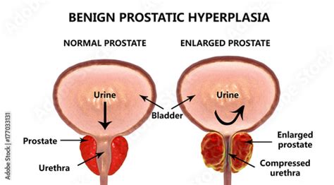 Benign prostatic hyperplasia, 3D illustration showing normal and ...
