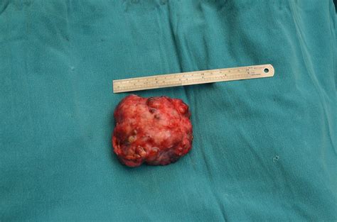 Benign Tumor Removal from the Breasts