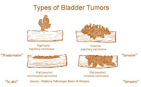 Benigni: Benign Tumor Bladder