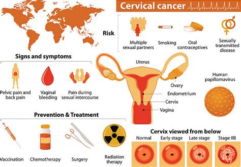 Best Cervical Cancer Illustrations, Royalty Free Vector ...