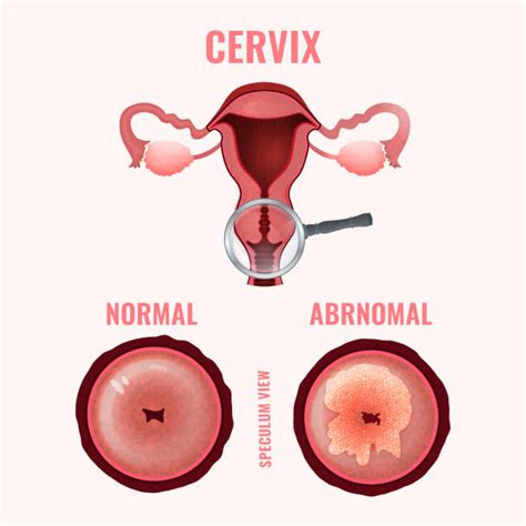Best Cervix Illustrations, Royalty Free Vector Graphics ...