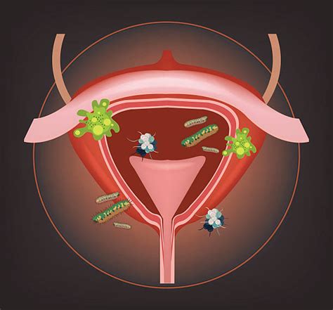 Best Urinary Tract Infection Illustrations, Royalty Free ...