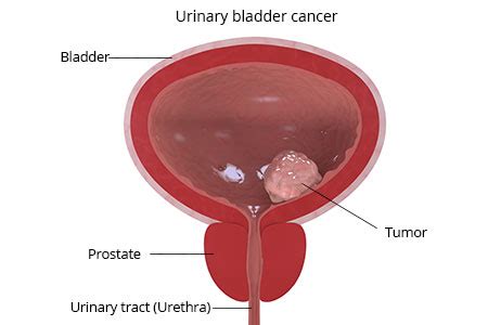 Bladder and Prostate Cancer Early Detection