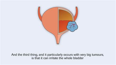 Bladder cancer and its signs and symptoms   YouTube