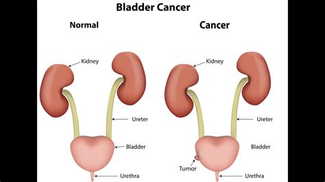 Bladder cancer | Bladder infection symptoms | Chemotherapy ...