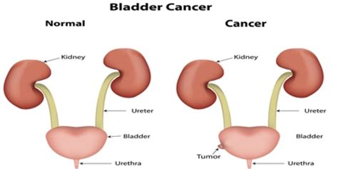 Bladder Cancer: Causes, Symptoms and Treatment ...