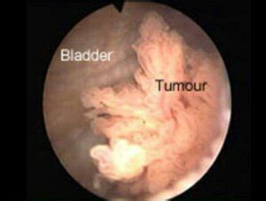 Bladder cancer Causes, Symptoms, Diagnosis & Treatment ...