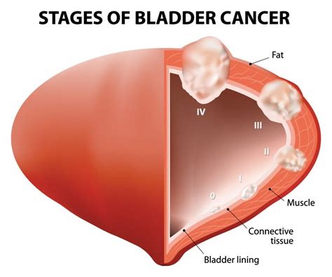 Bladder Cancer   DiseasesAndConditions.net