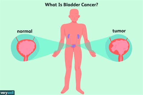 Bladder Cancer: Overview and More