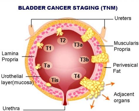 Bladder Cancer – Characteristics, Symptoms and Risk ...