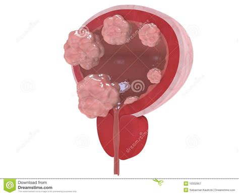 Bladder cancer stages stock illustration. Image of tumor ...