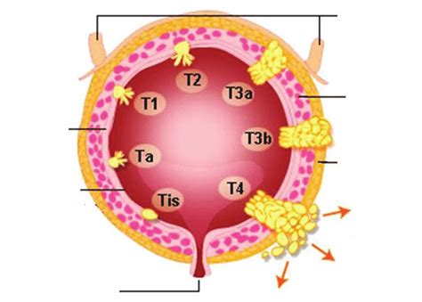 Bladder cancer staging  TNM . TNM = tumor, node ...