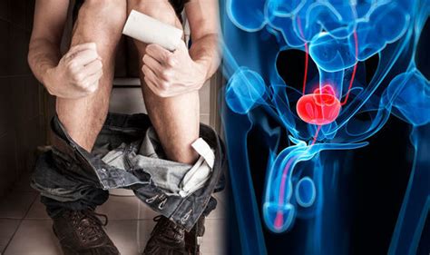 Bladder cancer symptoms and signs: Three toilet habits ...