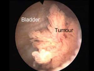Bladder cancer treatment in india