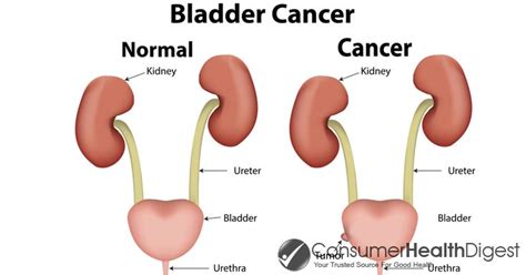 Bladder Cancer: Types, Symptoms, Causes, Diagnosis ...