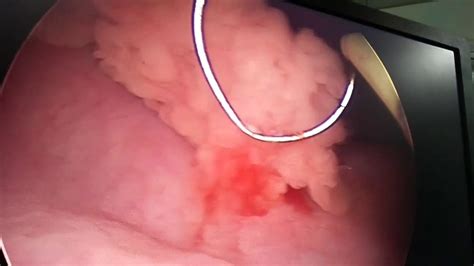 Bladder tumor removal by TURBT, by Urologist Dr Raj kumar ...