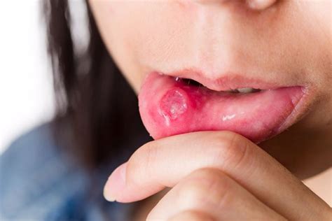 Blister on Lip Causes, Treatment, and Prevention ...