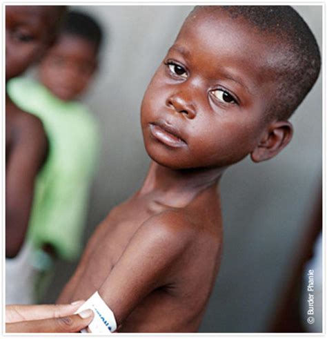Blog de Cami: Desnutrición Infantil