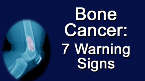 Bone Cancer   7 Warning Signs   YouTube
