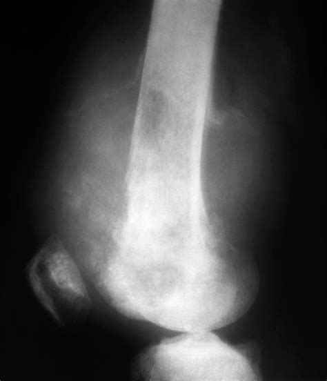 Bone Cancer In The Femur Photograph by Zephyr/science ...