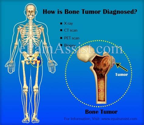 Bone Cancer Symptoms Hip   Cancer News Update