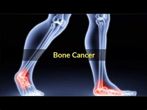 Bone Cancer Symptoms – Pictures, Causes and Symptoms of ...