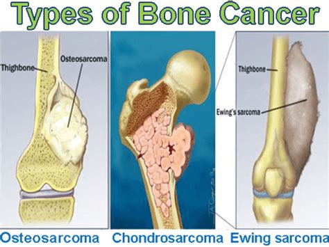 Bone Cancer Treatment | Bone Cancer Doctor In Delhi NCR