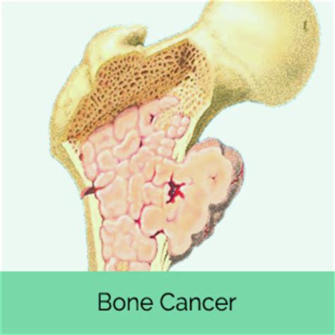 Bone cancer Types, Causes, Symptoms and treatment ...
