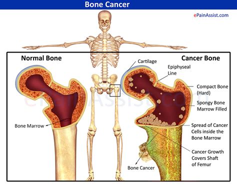 Bone Cancer|Types|Stages|Causes|Symptoms|Treatment Surgery ...