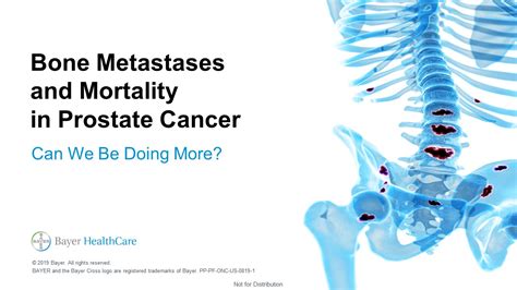 Bone Metastases & Mortality in Prostate Cancer | Battle in ...