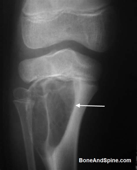 Bone Tumors Images and Xrays | Bone and Spine