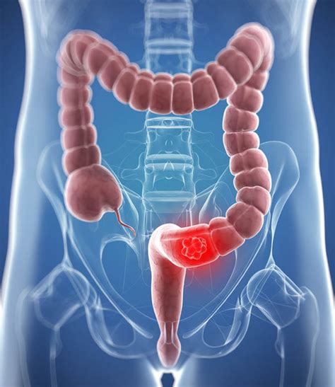 Bowel cancer cause: Western high meat fatty diet  causes ...