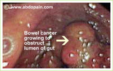 Bowel Cancer | Causes, Diagnosis, Screening Programs and ...