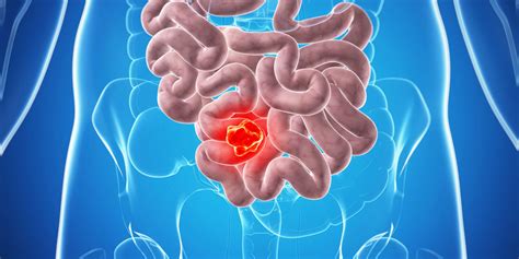 Bowel cancer  colon cancer : causes, symptoms, diagnosis