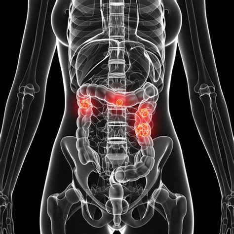 Bowel cancer symptoms: Are you at risk? Persistent stomach ...