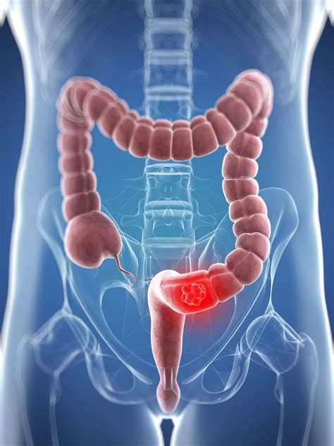 Bowel cancer symptoms: Are you at risk? This sign in your ...