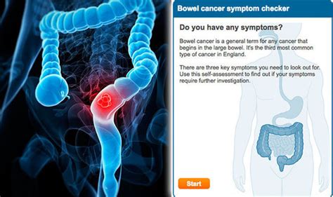 Bowel cancer symptoms: NHS quiz reveals your risk of ...